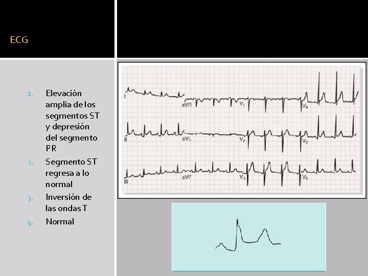 ECG 1. 2. 3. 4. Elevación amplia de los segmentos ST y depresión del ECG 1. 2. 3. 4. Elevación amplia de los segmentos ST y depresión del