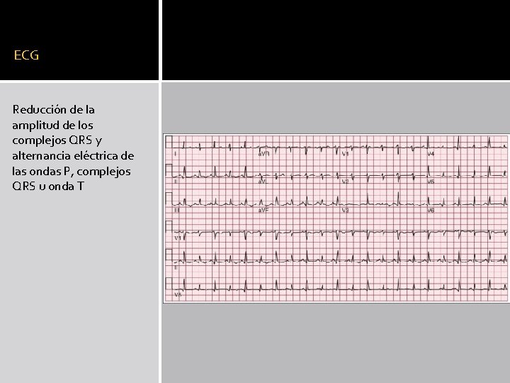 ECG Reducción de la amplitud de los complejos QRS y alternancia eléctrica de las ECG Reducción de la amplitud de los complejos QRS y alternancia eléctrica de las