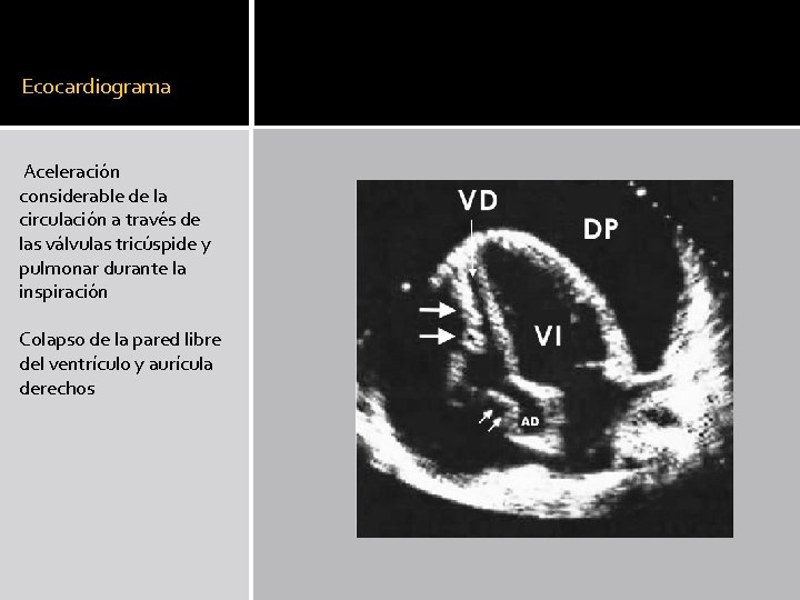 Ecocardiograma Aceleración considerable de la circulación a través de las válvulas tricúspide y pulmonar Ecocardiograma Aceleración considerable de la circulación a través de las válvulas tricúspide y pulmonar