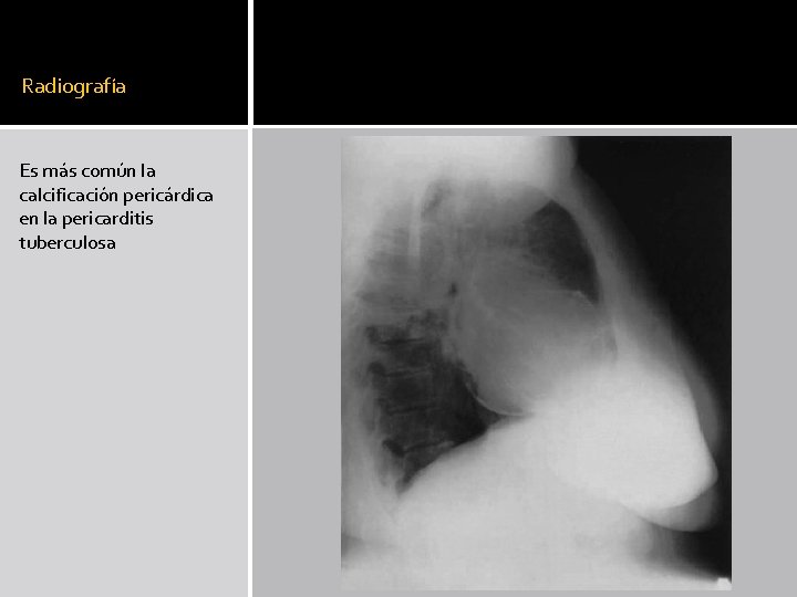 Radiografía Es más común la calcificación pericárdica en la pericarditis tuberculosa Radiografía Es más común la calcificación pericárdica en la pericarditis tuberculosa