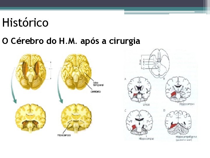 Histórico O Cérebro do H. M. após a cirurgia 