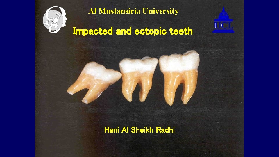 Al Mustansiria University Impacted and ectopic teeth Hani Al Sheikh Radhi 