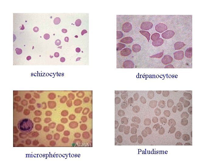 schizocytes microsphérocytose drépanocytose Paludisme 
