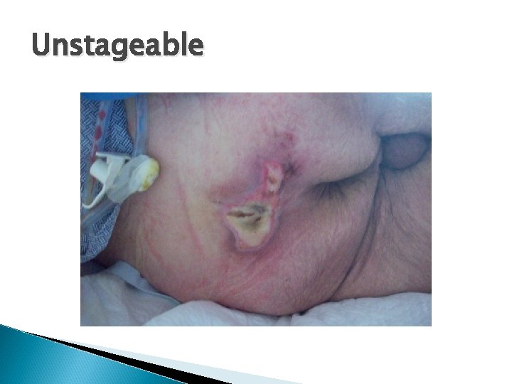 Unstageable Unstageable