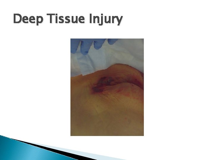 Deep Tissue Injury 