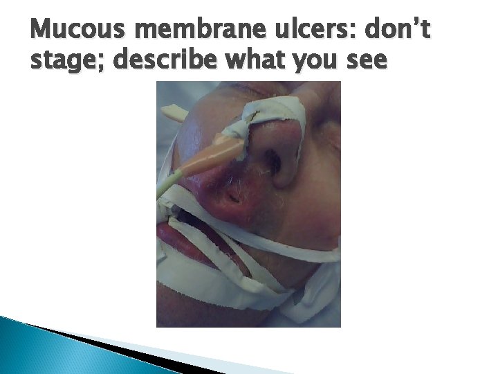 Mucous membrane ulcers: don’t stage; describe what you see 