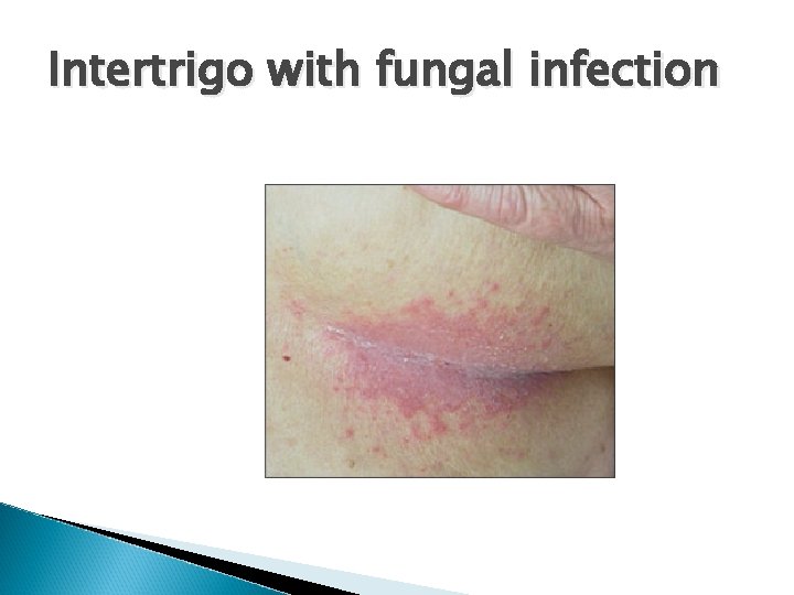 Intertrigo with fungal infection 