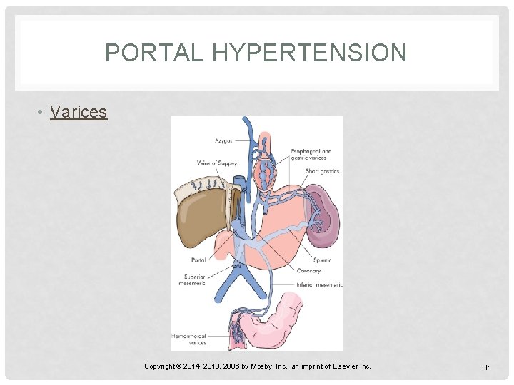 PORTAL HYPERTENSION • Varices Copyright © 2014, 2010, 2006 by Mosby, Inc. , an