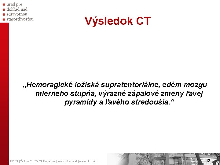 Výsledok CT „Hemoragické ložiská supratentoriálne, edém mozgu mierneho stupňa, výrazné zápalové zmeny ľavej pyramídy