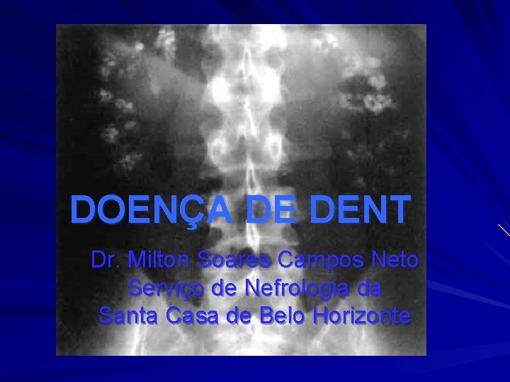 DOENÇA DE DENT Dr. Milton Soares Campos Neto Serviço de Nefrologia da Santa Casa