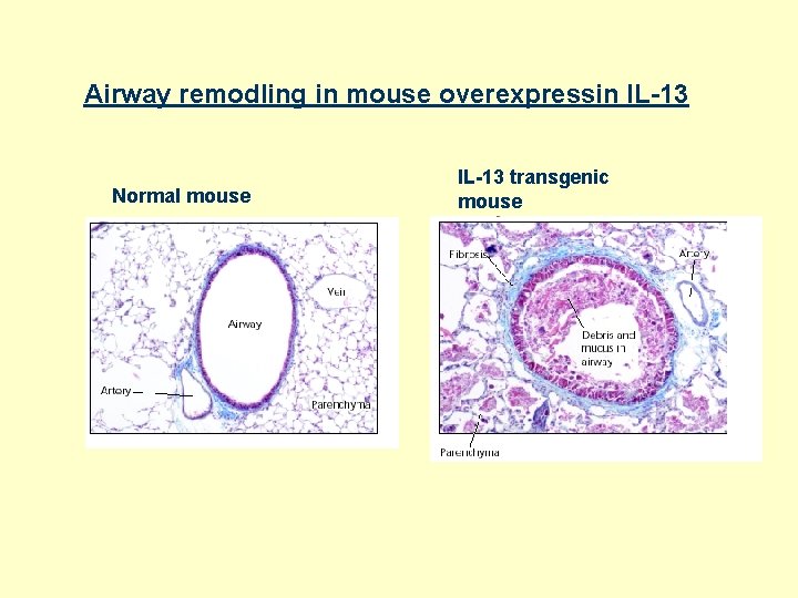 Airway remodling in mouse overexpressin IL-13 Normal mouse IL-13 transgenic mouse 