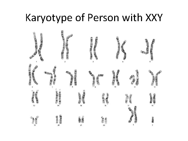 Karyotype of Person with XXY 