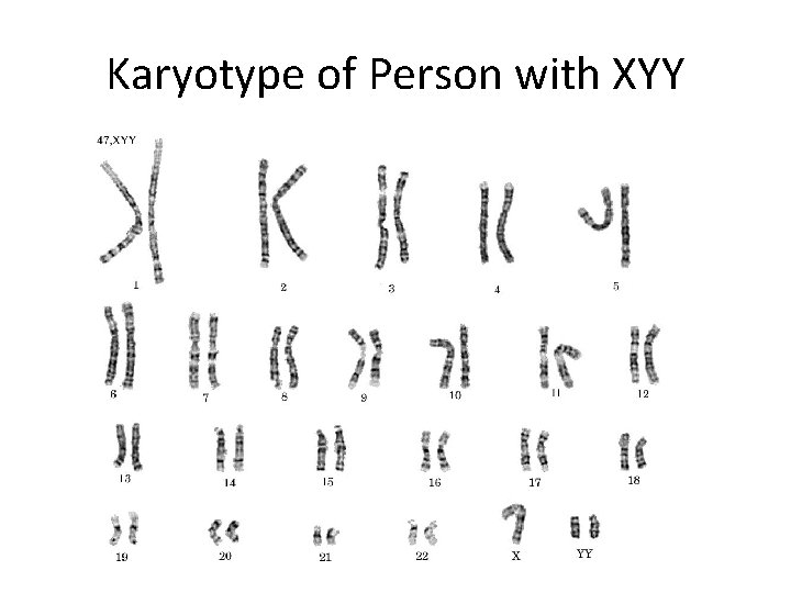 Karyotype of Person with XYY 