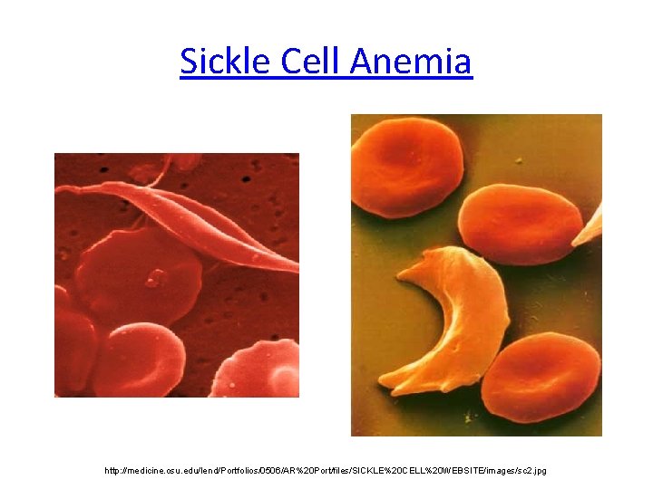 Sickle Cell Anemia http: //medicine. osu. edu/lend/Portfolios/0506/AR%20 Port/files/SICKLE%20 CELL%20 WEBSITE/images/sc 2. jpg 