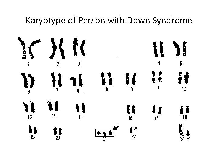 Karyotype of Person with Down Syndrome 