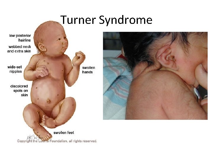 Turner Syndrome 