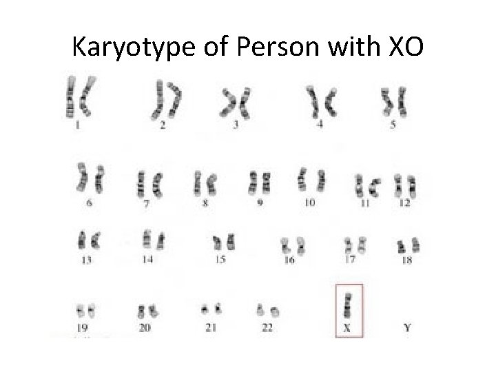 Karyotype of Person with XO 