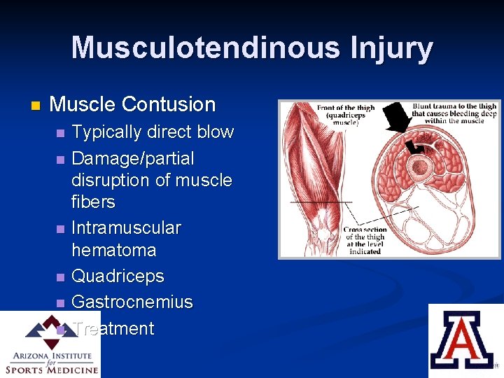 Musculotendinous Injury n Muscle Contusion n n n Typically direct blow Damage/partial disruption of
