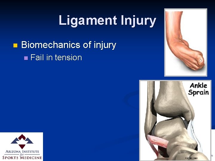 Ligament Injury n Biomechanics of injury n Fail in tension 