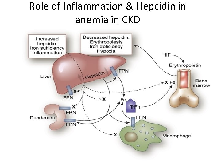 Role of Inflammation & Hepcidin in anemia in CKD 