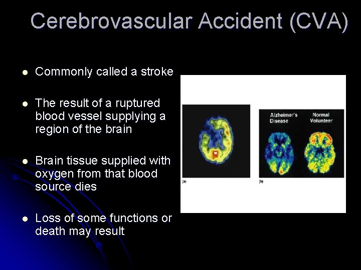 Cerebrovascular Accident (CVA) l Commonly called a stroke l The result of a ruptured