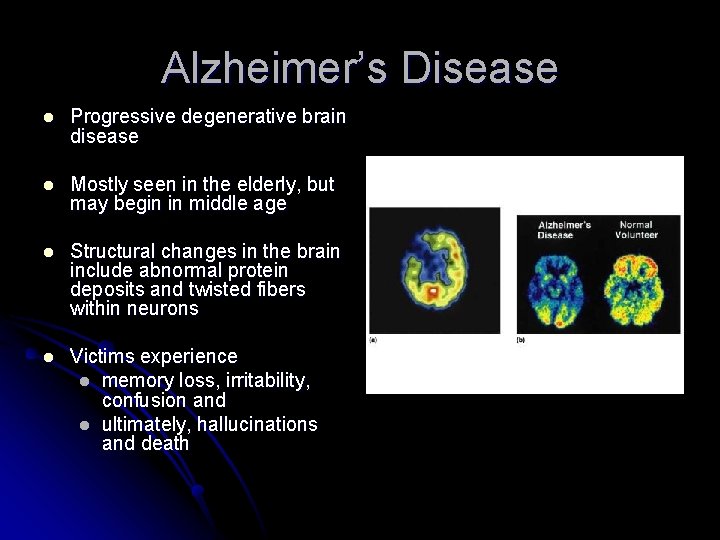 Alzheimer’s Disease l Progressive degenerative brain disease l Mostly seen in the elderly, but