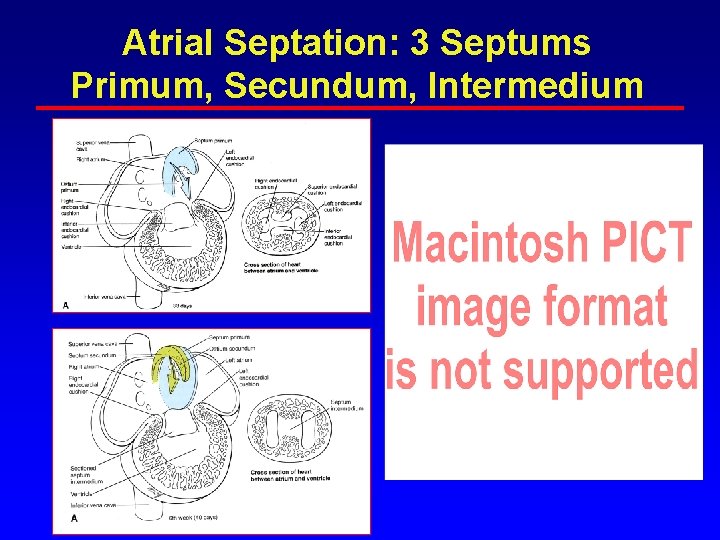 Atrial Septation: 3 Septums Primum, Secundum, Intermedium Atrial Septation: 3 Septums Primum, Secundum, Intermedium