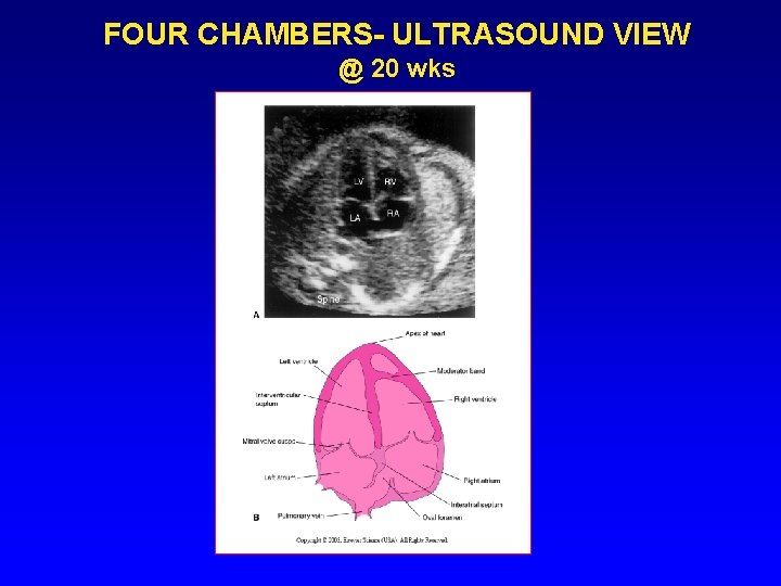 FOUR CHAMBERS- ULTRASOUND VIEW @ 20 wks FOUR CHAMBERS- ULTRASOUND VIEW @ 20 wks