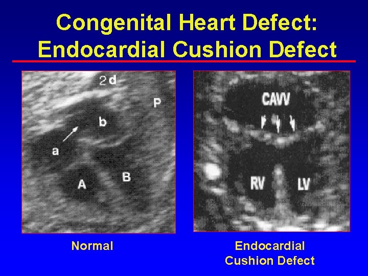 Congenital Heart Defect: Endocardial Cushion Defect Normal Endocardial Cushion Defect Congenital Heart Defect: Endocardial Cushion Defect Normal Endocardial Cushion Defect