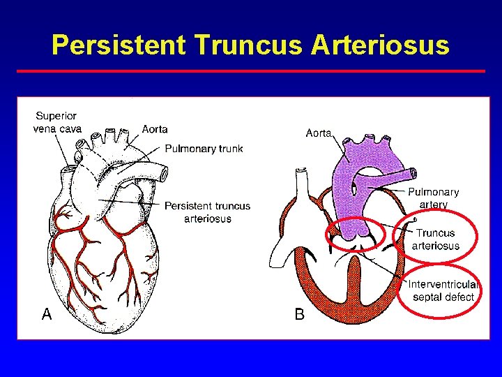 Persistent Truncus Arteriosus Persistent Truncus Arteriosus