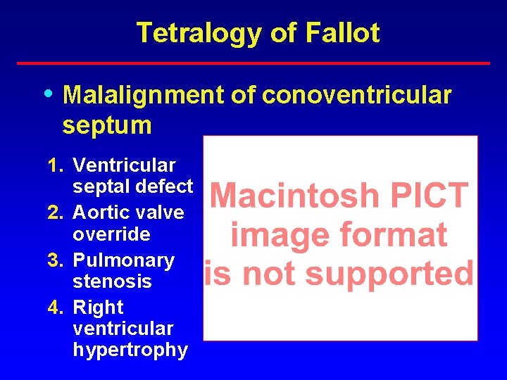 Tetralogy of Fallot • Malalignment of conoventricular septum 1. Ventricular septal defect 2. Aortic Tetralogy of Fallot • Malalignment of conoventricular septum 1. Ventricular septal defect 2. Aortic