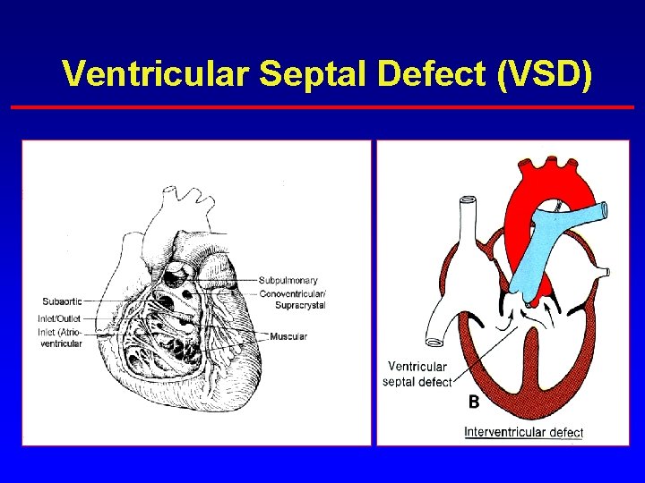 Ventricular Septal Defect (VSD) Ventricular Septal Defect (VSD)