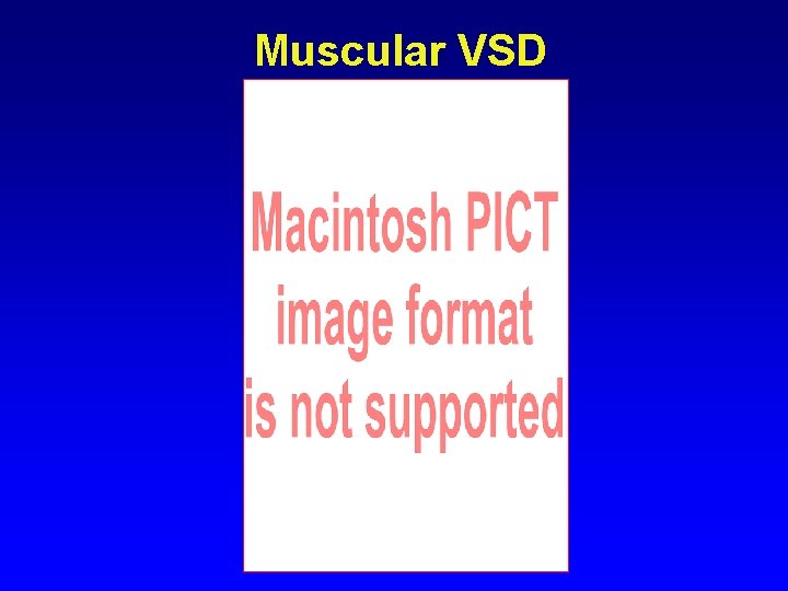 Muscular VSD Muscular VSD