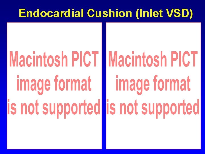 Endocardial Cushion (Inlet VSD) Endocardial Cushion (Inlet VSD)