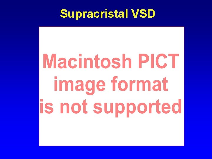 Supracristal VSD Supracristal VSD