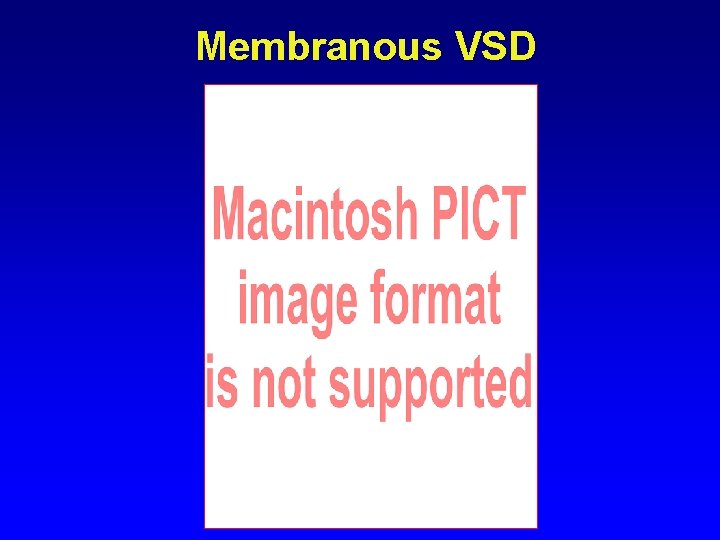 Membranous VSD Membranous VSD
