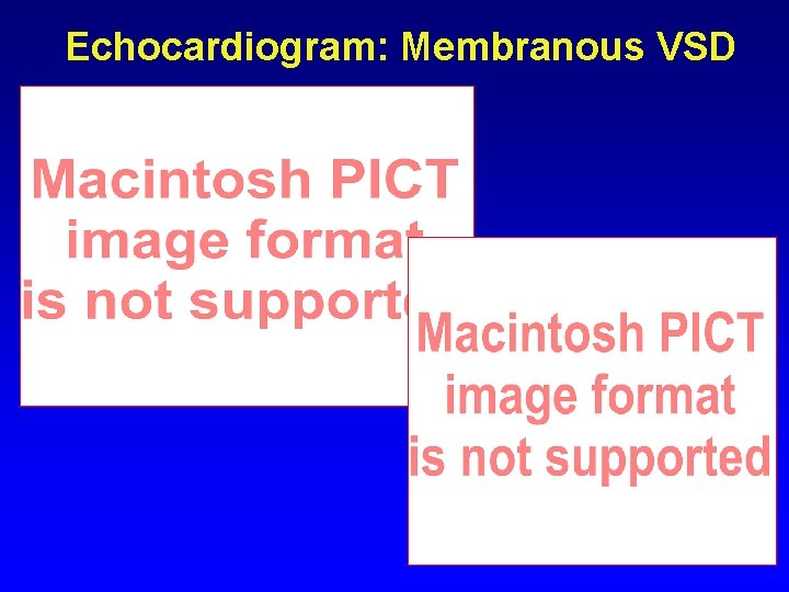 Echocardiogram: Membranous VSD Echocardiogram: Membranous VSD