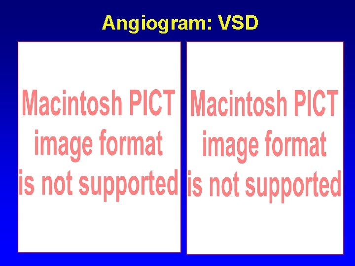 Angiogram: VSD Angiogram: VSD
