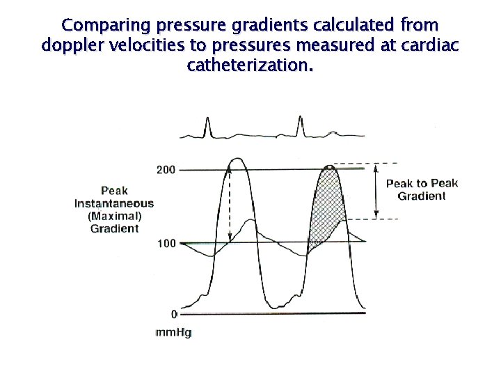 Comparing pressure gradients calculated from doppler velocities to pressures measured at cardiac catheterization. Comparing pressure gradients calculated from doppler velocities to pressures measured at cardiac catheterization.