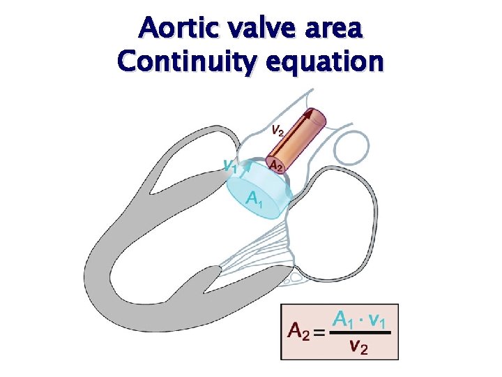 Aortic valve area Continuity equation Aortic valve area Continuity equation