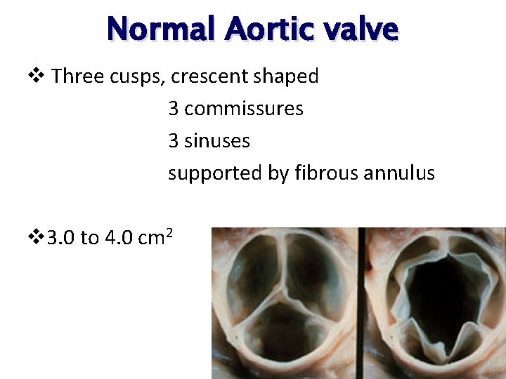 Normal Aortic valve v Three cusps, crescent shaped 3 commissures 3 sinuses supported by Normal Aortic valve v Three cusps, crescent shaped 3 commissures 3 sinuses supported by