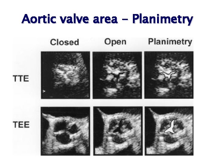 Aortic valve area - Planimetry Aortic valve area - Planimetry