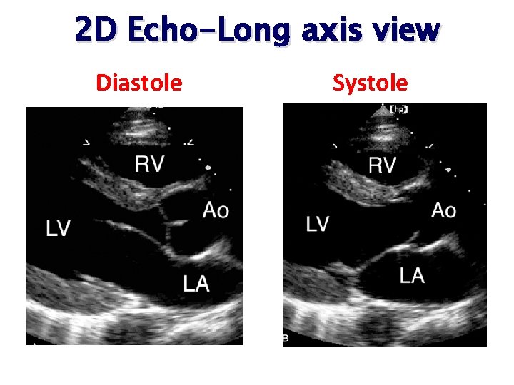 2 D Echo-Long axis view Diastole Systole 2 D Echo-Long axis view Diastole Systole