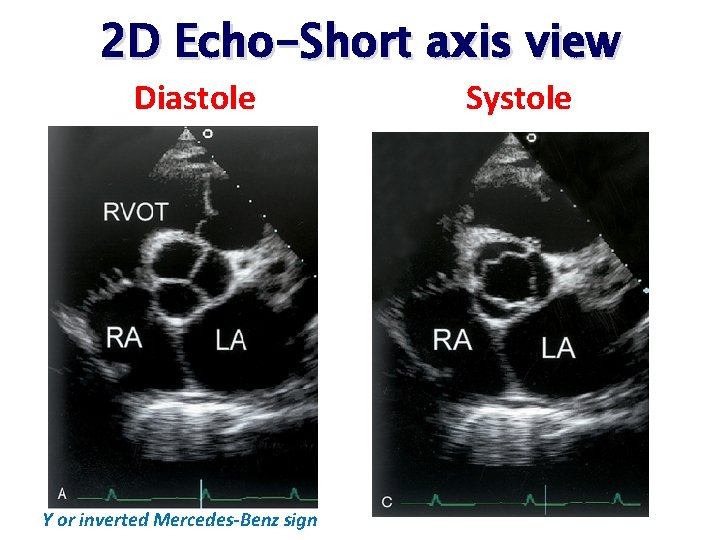2 D Echo-Short axis view Diastole Y or inverted Mercedes-Benz sign Systole 2 D Echo-Short axis view Diastole Y or inverted Mercedes-Benz sign Systole