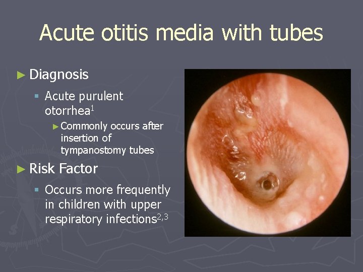 Acute otitis media with tubes ► Diagnosis § Acute purulent otorrhea 1 ► Commonly Acute otitis media with tubes ► Diagnosis § Acute purulent otorrhea 1 ► Commonly
