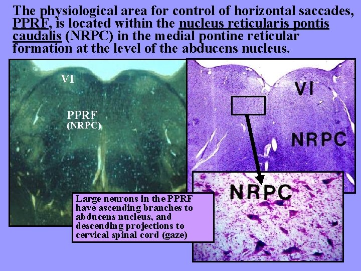 The physiological area for control of horizontal saccades, PPRF, is located within the nucleus
