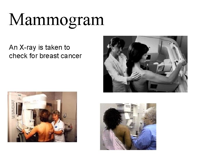 Mammogram An X-ray is taken to check for breast cancer 