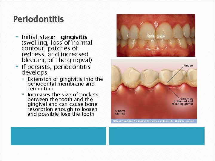 Periodontitis Initial stage: gingivitis (swelling, loss of normal contour, patches of redness, and increased