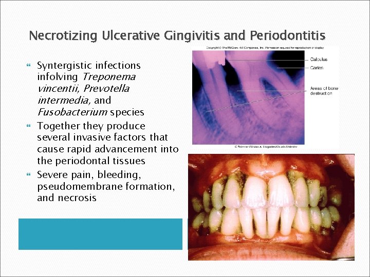 Necrotizing Ulcerative Gingivitis and Periodontitis Syntergistic infections infolving Treponema vincentii, Prevotella intermedia, and Fusobacterium