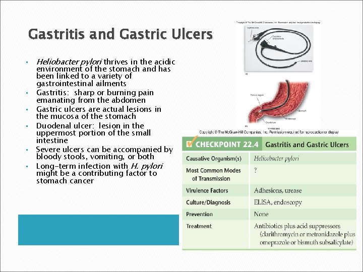 Gastritis and Gastric Ulcers • • • Heliobacter pylori thrives in the acidic environment